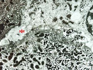 F,7m. | giant cell hepatitis* - dilated bile duct F,7m. | giant cell hepatitis* - dilated bile duct